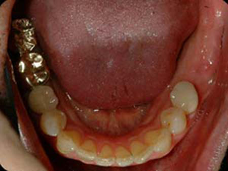 partially edentulous tooth 